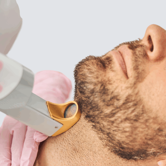 10 Face & Neck Laser Hair Removal treatments