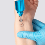 Laser Tattoo removal 2inchx2inch