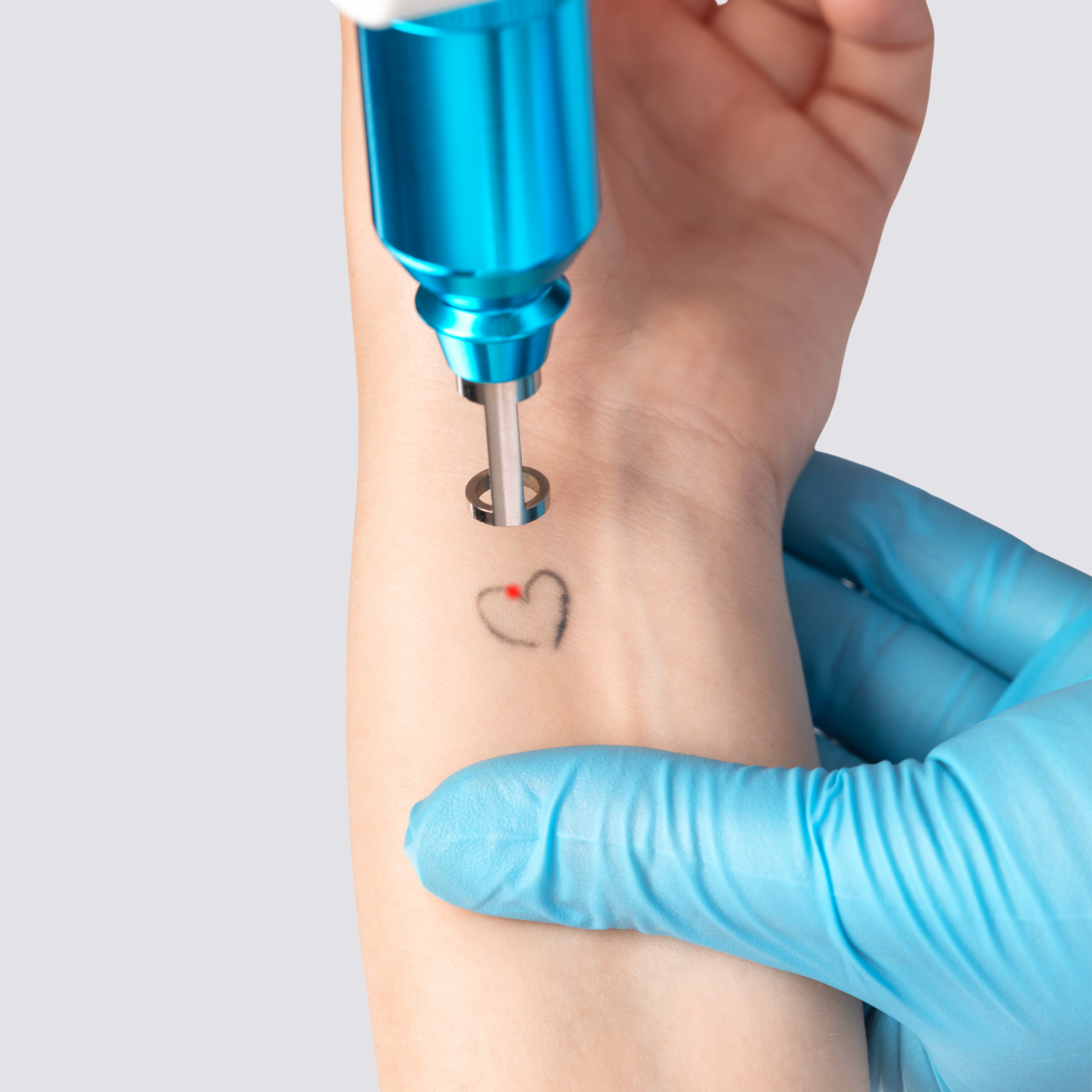 Laser Tattoo removal 2inchx2inch