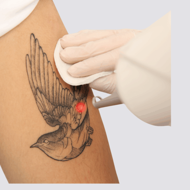 Laser Tattoo removal 5inchx5inch