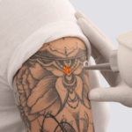 Laser Tattoo removal 7inchx7inch